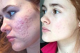 Best Acne Scar Treatment for Acne-Prone Skin Dubai 