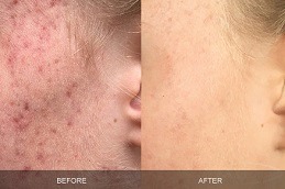 Best Acne Scar Treatment for African American Skin in Dubai