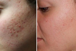 Best Acne Scar Treatment for Brown Skin Dubai