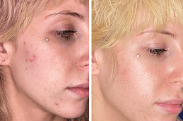 Best Acne Scar Treatment for Brown Skin in Dubai