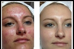 Best Acne Scar Treatment for Sensitive Skin in Dubai
