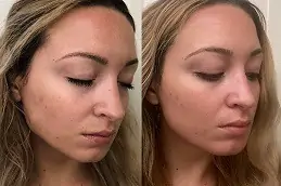 Best Acne Scar Treatment for Teenagers Dubai
