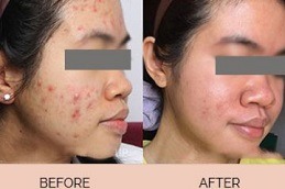 Best Acne Scar Treatment for Teenagers in Dubai
