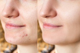 Best Acne Treatment for Dry Sensitive Skin Dubai