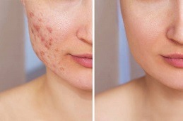 Best Acne Treatment for Dry Sensitive Skin in Dubai
