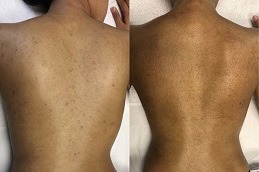 Best Back Facial Treatment Clinic Dubai & Abu Dhabi