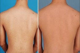 Best Back Facial Treatment Clinic in Dubai & Abu Dhabi