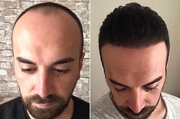 Best Can a 21 or 22-Year-Old Person Get a Hair Transplant in Dubai