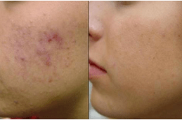 Best Clinic of Acne Scar Treatment for African American Skin in Dubai