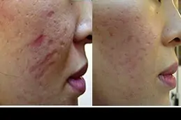 Best Clinic of Acne Scar Treatment for Brown Skin Dubai