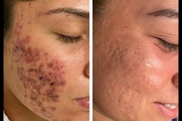 Best Clinic of Acne Scar Treatment for Brown Skin in Dubai