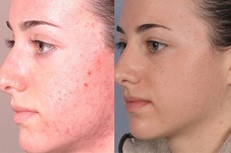 Best Clinic of Acne Scar Treatment for Sensitive Skin Dubai