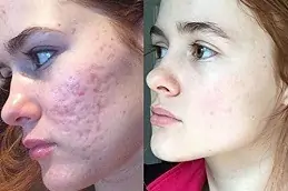 Best Clinic of Acne Scar Treatment for Teenagers Dubai