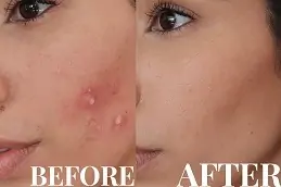 Best Clinic of Acne Scar Treatment for Teenagers in Dubai