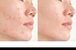 Best Clinic of Acne Treatment for Dry Sensitive Skin in Dubai