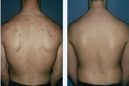 Best Clinic of Back Facial Treatment Clinic Dubai & Abu Dhabi