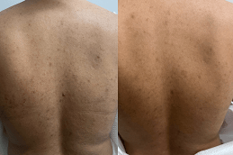 Best Clinic of Back Facial Treatment Clinic in Dubai & Abu Dhabi