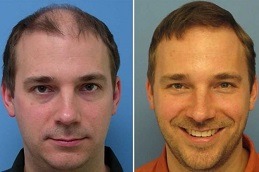 Best Clinic of Can a 21 or 22-Year-Old Person Get a Hair Transplant Dubai