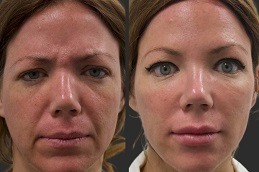 Best Clinic of Cost of Dermal Fillers for Nasolabial Folds Dubai