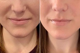 Best Clinic of Cost of Dermal Fillers for Nasolabial Folds in Dubai