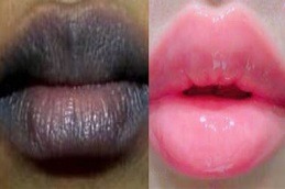 Best Clinic of Dark Lips Treatment by Dermatologist Dubai