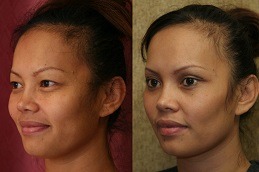 Best Clinic of Eyelid Surgery for Droopy Eyelids Dubai