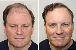 Best Clinic of Hair Transplant for Front Head in Dubai & Abu Dhabi