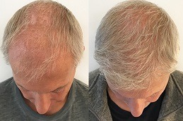 Best Clinic of Hair Transplant for White Hair Dubai