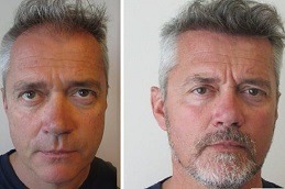 Best Clinic of Hair Transplant for White Hair in Dubai