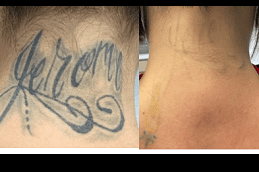 Best Clinic of Laser Tattoo Removal for Black Skin Dubai