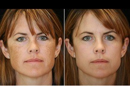 Best Clinic of Laser Treatment for Dark Spots on Face Price in Dubai