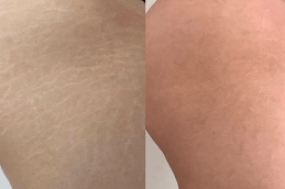 Best Clinic of Laser Treatment for Stretch Marks Dark Skin Dubai