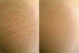 Best Clinic of Laser Treatment for Stretch Marks Dark Skin in Dubai