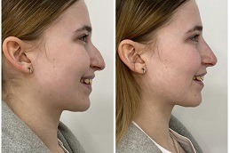 Best Clinic of Non Surgical Rhinoplasty Cost in Dubai & Abu Dhabi