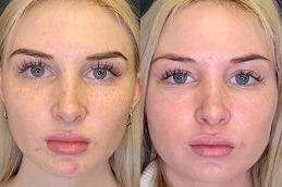 Best Clinic of PRP Injections for Face Cost in Dubai UAE