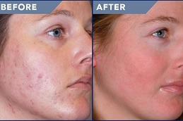 Best Clinic of Pimples Treatment Cost in Dubai & Abu Dhabi