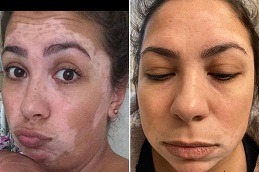 Best Clinic of Skin Whitening Treatment for Vitiligo Patients Dubai