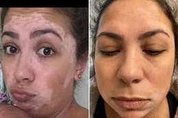 glutathione injection for vitiligo Skin Whitening Treatment Patients In Dubai & Abu Dhabi كريم يفتح تحت العين