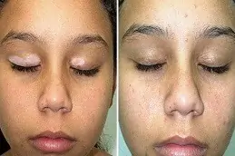 Best Clinic of Skin Whitening Treatment for Vitiligo Patients in Dubai