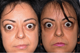 Best Eyelid Surgery for Thyroid Eye Disease in Dubai