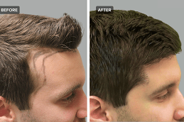 Best Hair Transplant for Male Pattern Baldness Cost in Dubai