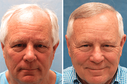Best Hair Transplant for White Hair Dubai