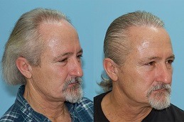 Best Hair Transplant for White Hair in Dubai