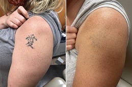 Best Laser Tattoo Removal for Black Skin Dubai
