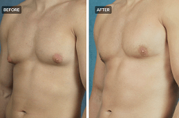 Best Liposuction Surgery for Gynecomastia Dubai