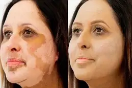 Best Skin Whitening Treatment for Vitiligo Patients Dubai