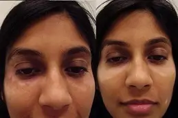 Best Skin Whitening Treatment for Vitiligo Patients in Dubai