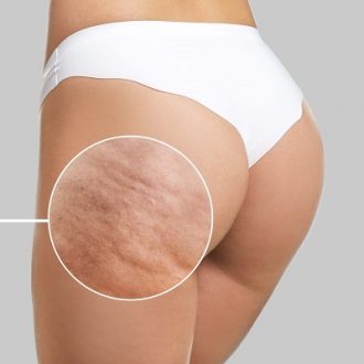 Cellulite Treatment Dubai Price & Cost
