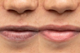 Dark Lips Treatment by Dermatologist Dubai
