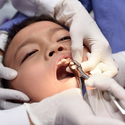 Dental Extraction in Dubai, Abu Dhabi & Sharjah Tooth Extraction